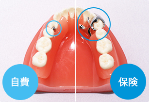 自費の入れ歯の特徴