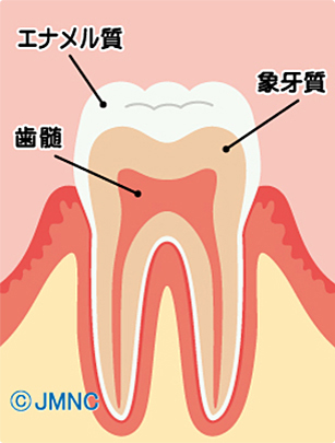 虫歯とは